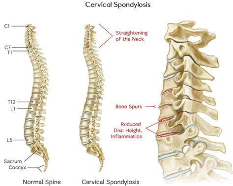 Cervical Spondylosis Causes Symptoms Exercises Treatment