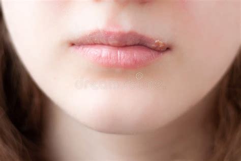 Girl`s Lips Close Up On The Upper Lip A Large Sore Herpes Stock Photo