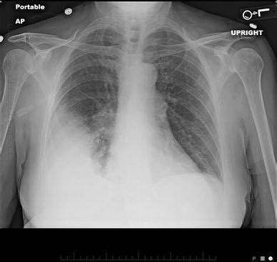 Legionella pneumophila is a gram negative, strictly aerobic bacterium of the. Legionella Pneumonia: When to Suspect, Diagnostic ...
