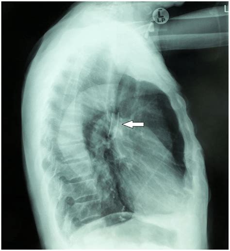 Chest X Ray Lateral View Showing The Fragment Of The Tracheostomy Tube