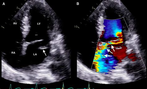 Cureus Emergent Diagnosis Of A Flail Mitral Leaflet With Bedside
