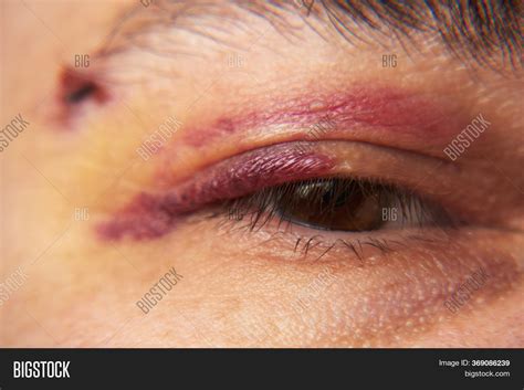 Close View Bruise Near Image And Photo Free Trial Bigstock