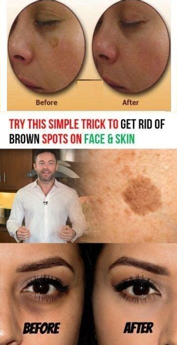 Age Spots Removal In 2020 Brown Spots On Face Spots On Face Brown