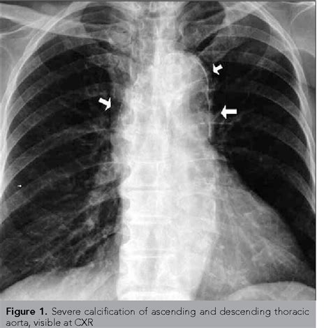 Figure 1 From Aortocoronary Bypass Surgery In A Patient With Severely