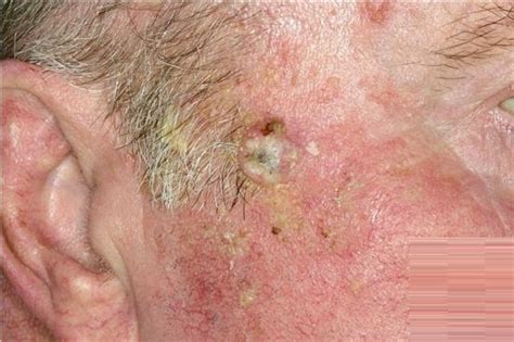 Actinic Keratosis Causes Symptoms And Treatment Hot Sex Picture
