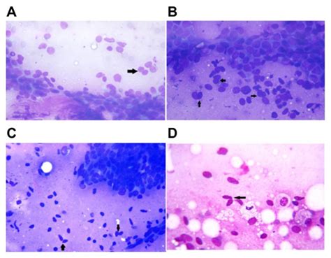 Cytology Of Benign Lesions Of Breast Showing Benign Pairs A