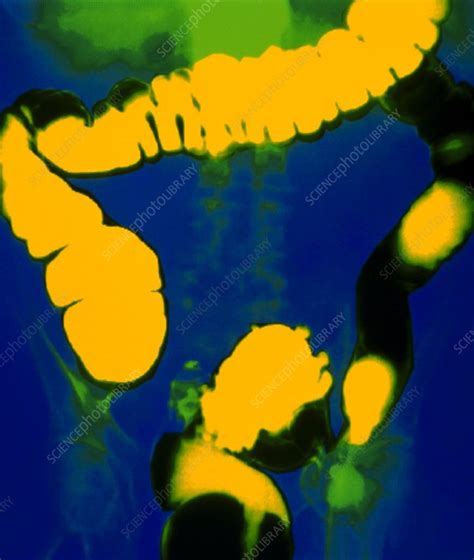 Coloured Gas Contrast X Ray Of The Colon Stock Image P5600076