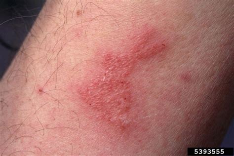 Rashes From Bed Bug Bites Images And Photos Finder