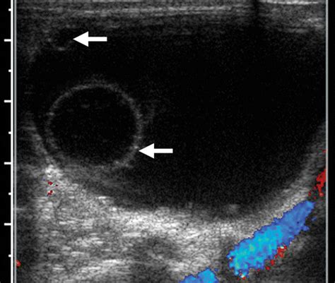 Fetal Ovarian Cysts Review Of Imaging Spectrum Differential Diagnosis