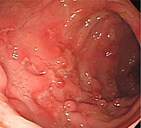 Figure 1 From A Case Of Crohn S Disease With Improvement After