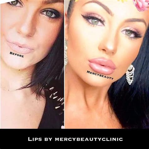 image result for keyhole lip injections before and after pictures with images lip