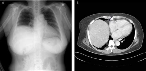 Figure 1 From A Case Of Primary Pericardial Malignant Mesothelioma