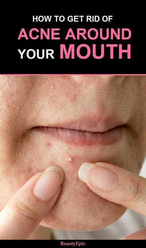 How To Get Rid Of Acne Around Mouth How To Get Rid Of Acne Home