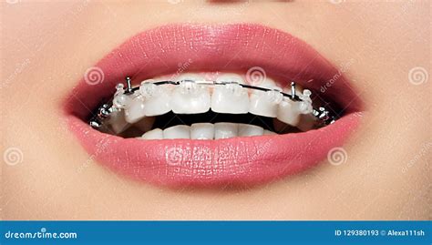 Braces On Teeth Dental Braces Smile Orthodontic Treatment Stock Image Image Of Align Face