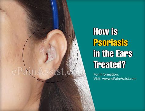 Presenting Features Of Psoriasis In The Ears And Its Treatment