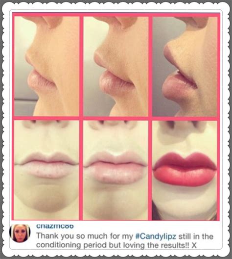 Most Outrageous Lip Lift Before And After Photos 9 Candylipz