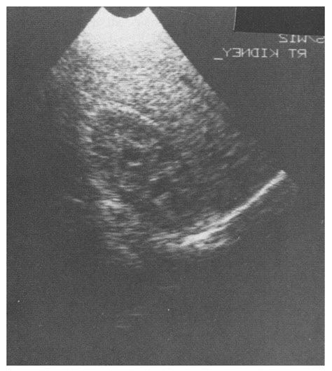 Longitudinal Ultrasound Image Of The Right Kidney Through The Liver