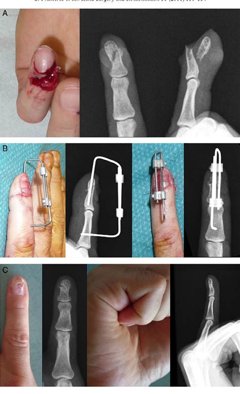 Distal Phalanx Fracture Finger
