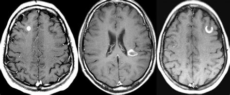 Diagnostico temprano de la esclerosis concentrica de balo mediante tractografia por tensor de difusion reporte de caso y revision medwave / multiple sclerosis (ms) can be pathologically defined as the presence of distributed glial scars. Esclerosis múltiple