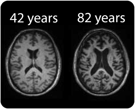 Mri Of Healthy Brain Aging A Review Macdonald Nmr In Biomedicine Wiley Online Library