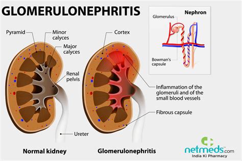 Pathophysiology Of Glomerulonephritis