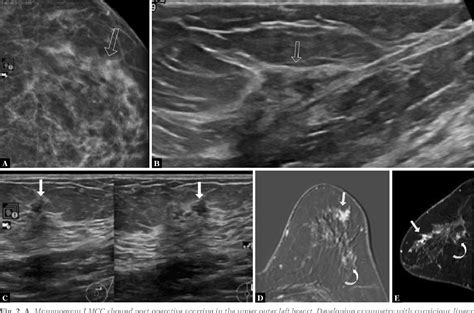 Figure 2 From Ultrasound Guided Vacuum Assisted Breast Biopsy In The