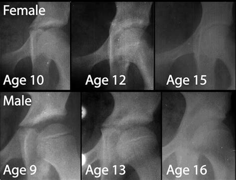 The ‘triradiate Bump A Novel Radiographic Sign That May Confound