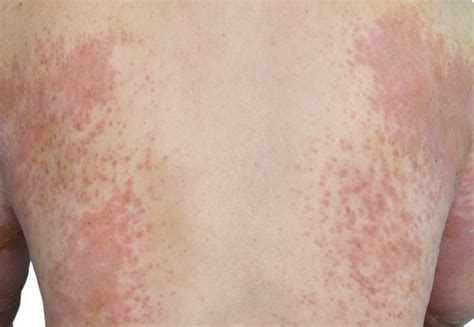 Immune System Overreaction May Trigger Eczema Into Becoming Long Term