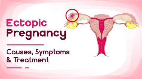 Ectopic Pregnancy Reasons Symptoms And Treatment Youtube