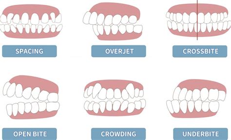 30312 Orthodontist Iconic Orthodontics Reasons To Get Braces