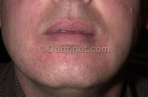 Seborrheic Dermatitis Photo Skin Disease Pictures