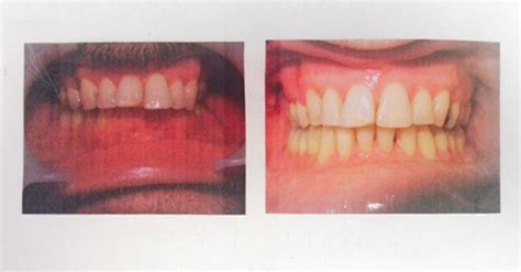 A Happy Patient Finishes Treatment Moira Wong Orthodontics