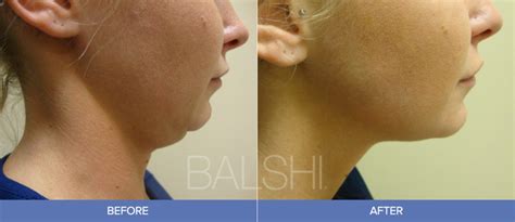 Thermitight® Delray Beach Tighten Your Skin At Balshi Dermatology