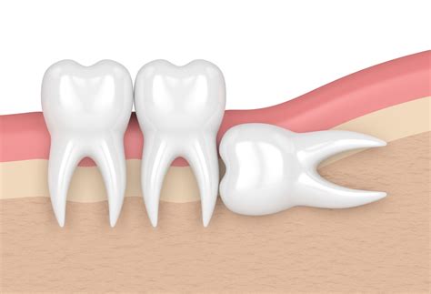 How We Extract Wisdom Teeth Santa Rosa And Rohnert Park Oral Surgery