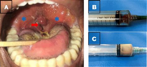 Case Report Bilateral Peritonsillar Abscess With F1000research