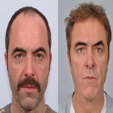 Hair replacement in delhi, non surgical hair replacement in delhi