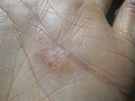 Dyshidrotic Eczema Hand Rash Triggered By Eating Soy Or Eg Flickr