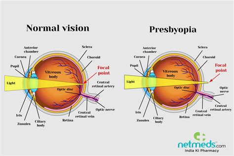 Presbyopia Causes Symptoms And Treatment