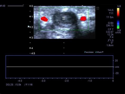 Penile Mondor Disease Superficial Venous Thrombosis Of The Dorsal Vein