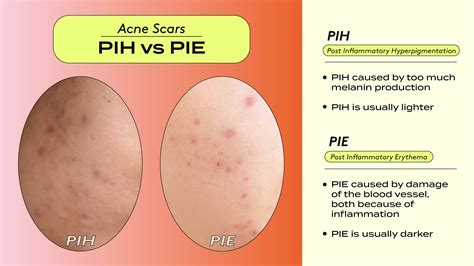 Perbedaan Pie Dan Pih Dengan Skincare Routine Untuk Mengatasinya