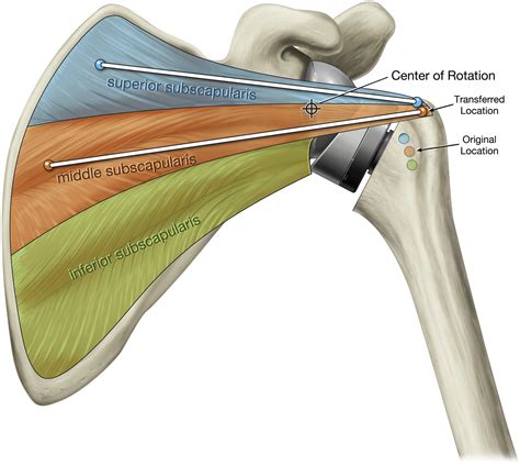 The Over The Top Subscapularis Repair In Reverse Shoulder Arthroplasty