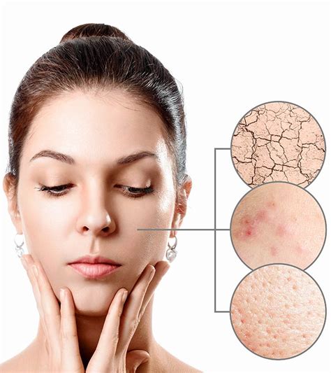 Dry skin is a skin type, which needs extra care and moisturization, but is still healthy skin. 12 Home Remedies To Remove Acne From Dry Skin
