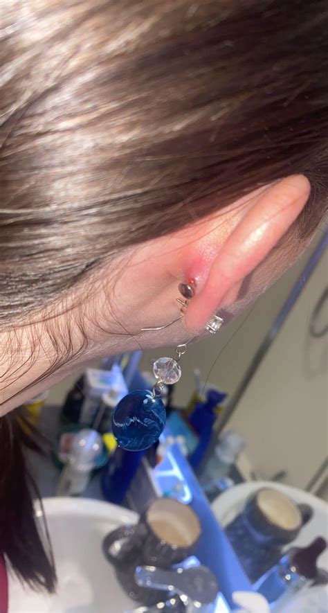 Is My Conch Piercing Infected Or Just Irritated Rpiercingadvice