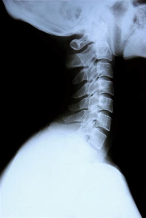 Learn how to make it at home by avoiding the most common mistakes. Cervical and Thoracic Spine