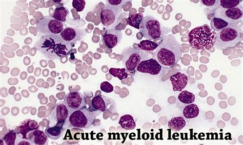Neonatal Acute Myeloid Leukemia In An Infant Whose Mother Was Exposed