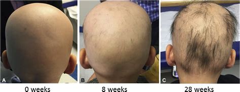 Topical 2 Tofacitinib For Children With Alopecia Areata Alopecia