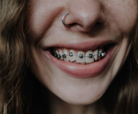 Why Are So Many People Getting Braces These Days Dentist Werribee