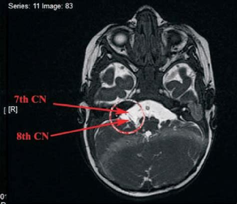 Mri Showing Hypoplasia Of Multiple Cranial Nerves On The Right Side
