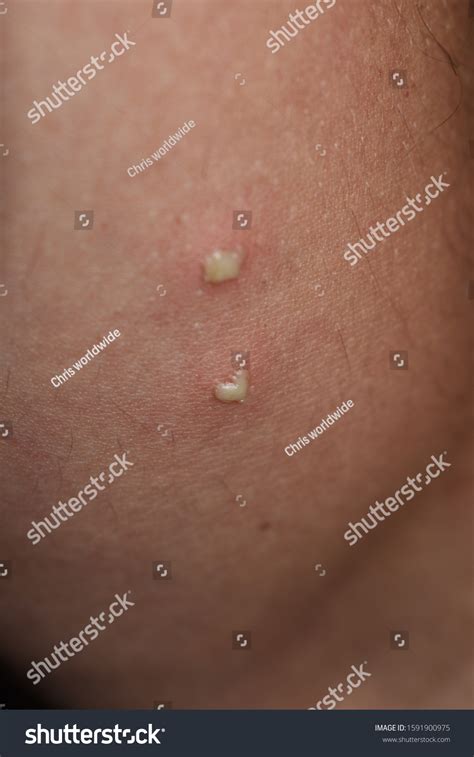 White Pimples On Human Skin Skin Stock Photo 1591900975 Shutterstock