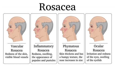 Best Essential Oil And Recipes For Rosacea Skin Essential Oil Benefits